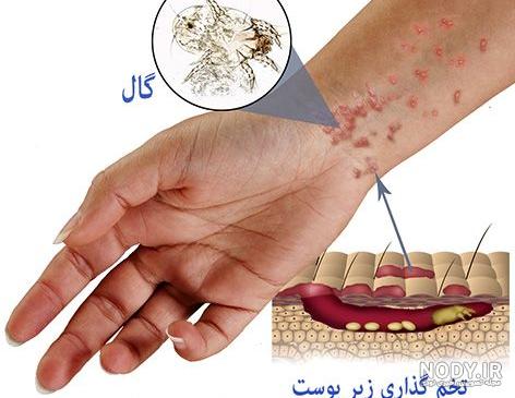 ایا بیماری گال خطرناک است