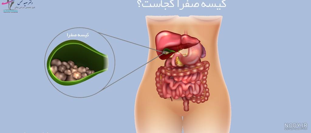 ایا سنگ کیسه صفرا باعث نفخ میشود ایا سنگ کیسه صفرا باعث نفخ میشود