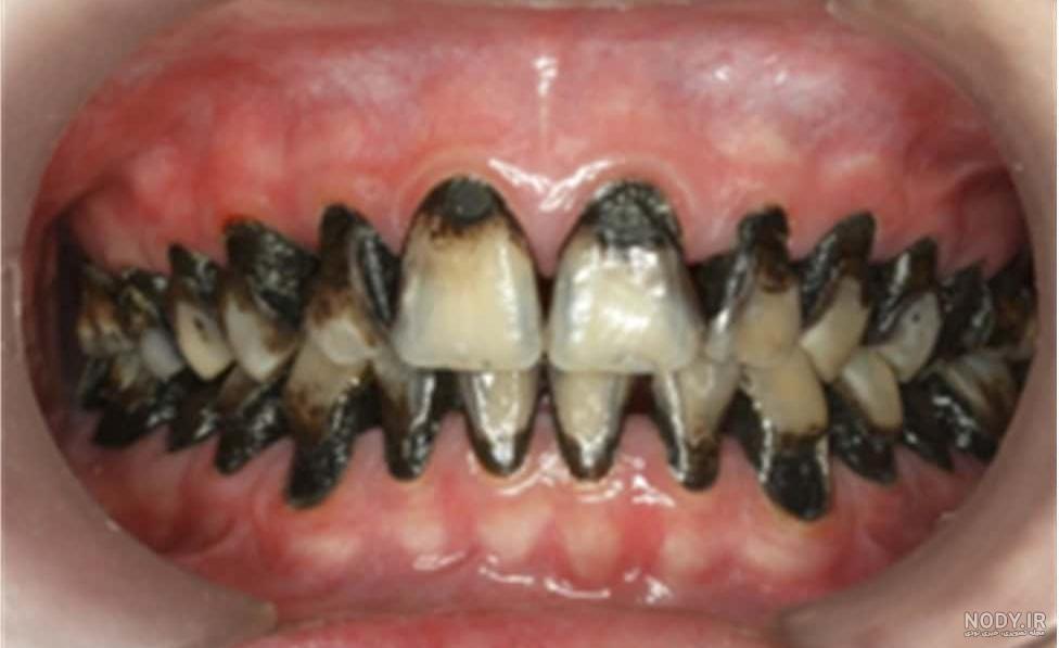 تغییرات چهره بعد از ترک سیگار