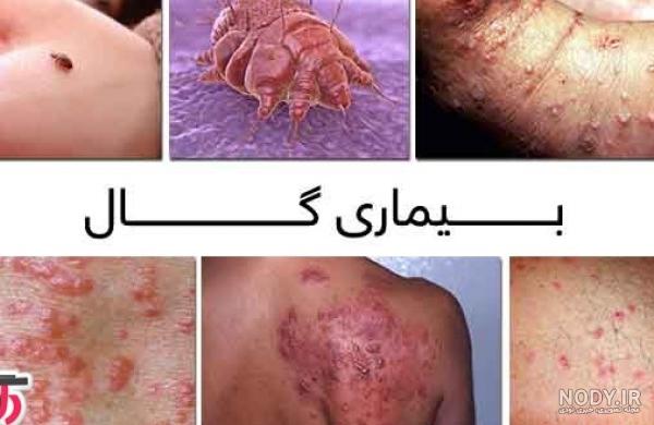 درمان بیماری گال با سرکه