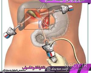 دفع سنگ کیسه صفرا با رژیم 2 روزه دکتر خوشبین دفع سنگ کیسه صفرا با رژیم 2 روزه دکتر خوشبین