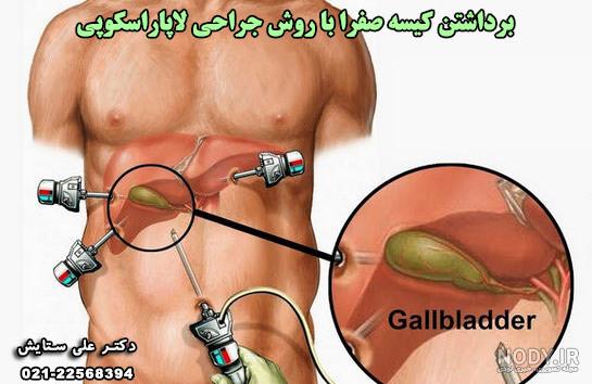 دمنوش برای سنگ صفرا نی نی سایت دمنوش برای سنگ صفرا نی نی سایت