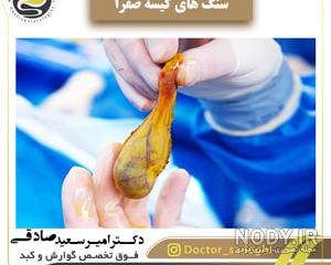 دکتر خوب برای کیسه صفرا نی نی سایت دکتر خوب برای کیسه صفرا نی نی سایت