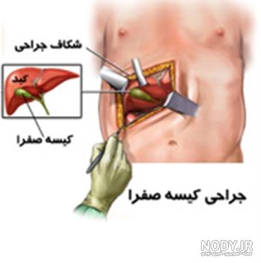 سنگ صفرا 14 میلی سنگ صفرا 14 میلی