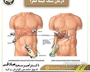عفونت کیسه صفرا چه علائمی دارد عفونت کیسه صفرا چه علائمی دارد