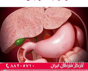 علائم سنگ کیسه صفرا چیست علائم سنگ کیسه صفرا چیست