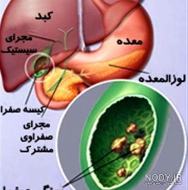 علائم پر شدن کیسه صفرا نی نی سایت علائم پر شدن کیسه صفرا نی نی سایت