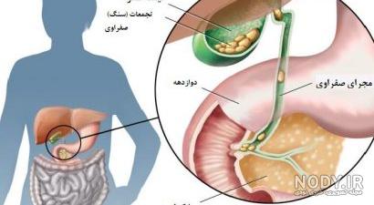 علائم کیسه صفرا در زنان نی نی سایت علائم کیسه صفرا در زنان نی نی سایت