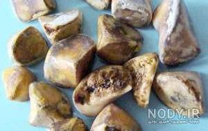 علائم کیسه صفرا در زنان نی نی سایت علائم کیسه صفرا در زنان نی نی سایت