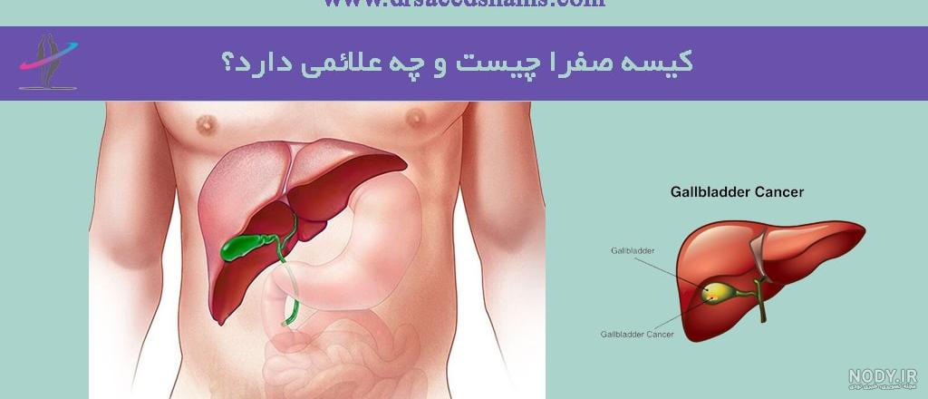 علائم کیسه صفرا در مردان علائم کیسه صفرا در مردان