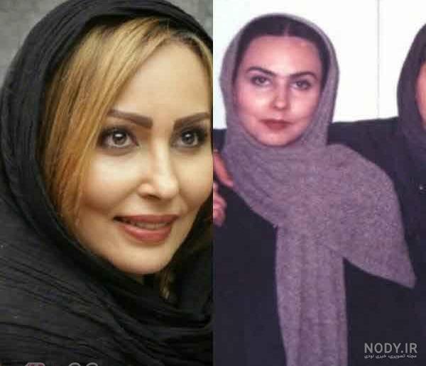 عکس بازیگران ترکیه قبل و بعد از عمل زیبایی عکس بازیگران ترکیه قبل و بعد از عمل زیبایی