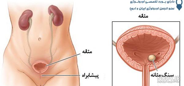 عکس سنگ مثانه