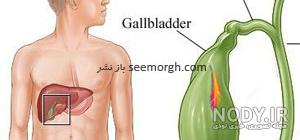 لیزر سنگ صفرا نی نی سایت لیزر سنگ صفرا نی نی سایت