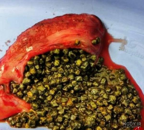 کپسول دفع سنگ کیسه صفرا کپسول دفع سنگ کیسه صفرا