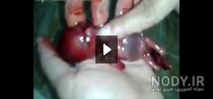 علائم سقط جنین یک ماهه نی نی سایت