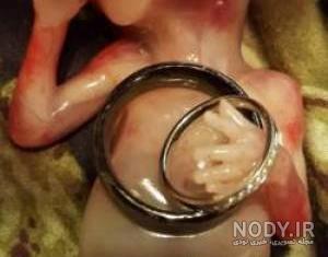 عکس از جنین یک ماهه سقط شده