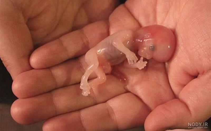 عکس جفت جنین سقط شده یک ماهه
