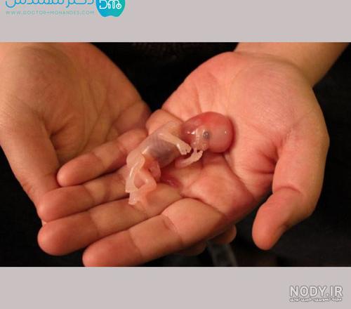 عکس جنین سقط شده یک ماهه
