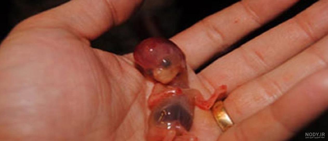 عکس جنین یک ماه سقط شده
