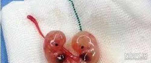 عکس جنین یک ماهه سقط شده نی نی سایت