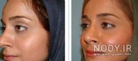 عکس گونه گذاری با ژل