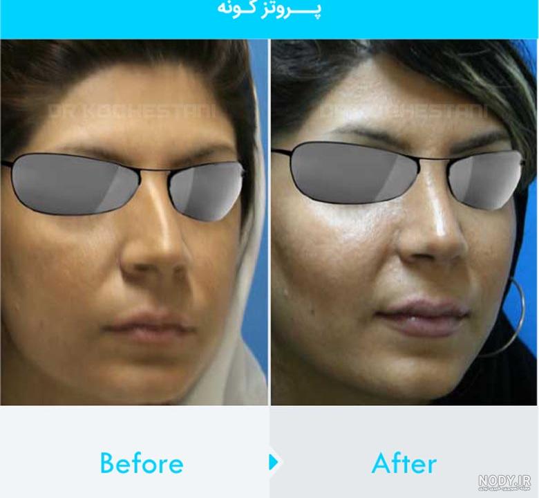 کاشت گونه با ژل