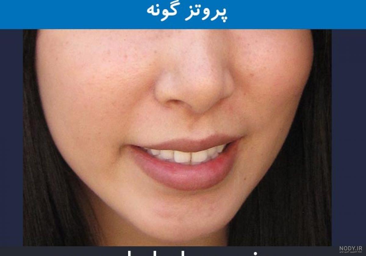 کاشت گونه طبیعی