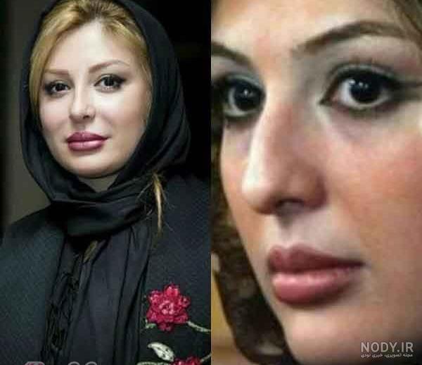 عکس بازیگران ترکیه قبل و بعد از عمل زیبایی