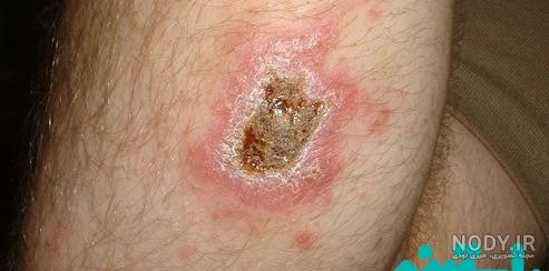 علائم عکس جوش اولیه سالک علائم عکس جوش اولیه سالک