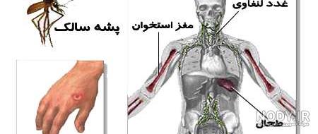 درمان خانگی سالک درمان خانگی سالک