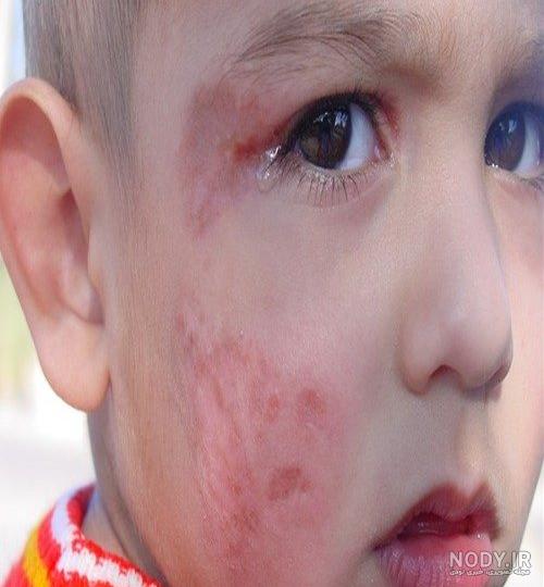 علائم عکس جوش اولیه سالک علائم عکس جوش اولیه سالک