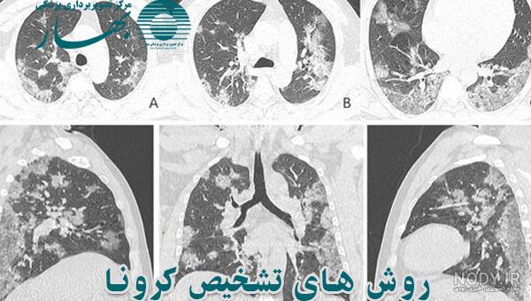 عکس ریه کرونای خفیف عکس ریه کرونای خفیف
