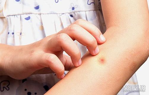 عکس نیش پشه سالک عکس نیش پشه سالک