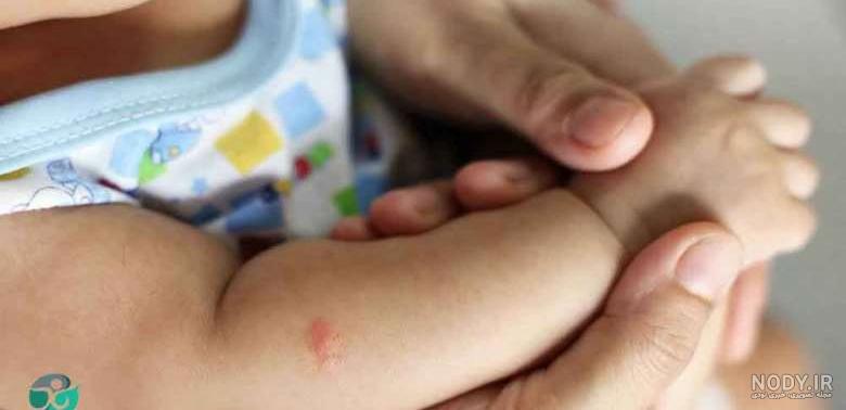 مراقبت از زخم سالک مراقبت از زخم سالک