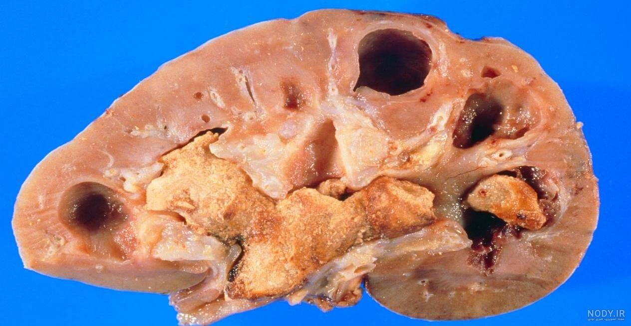 آیا سنگ کلیه خطرناک است آیا سنگ کلیه خطرناک است