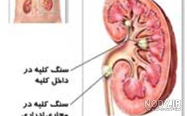 انواع سنگ کلیه بر اساس رنگ انواع سنگ کلیه بر اساس رنگ