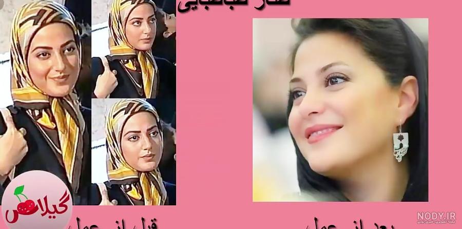 عکس دنیا جهانبخت بعد از عمل عکس دنیا جهانبخت بعد از عمل