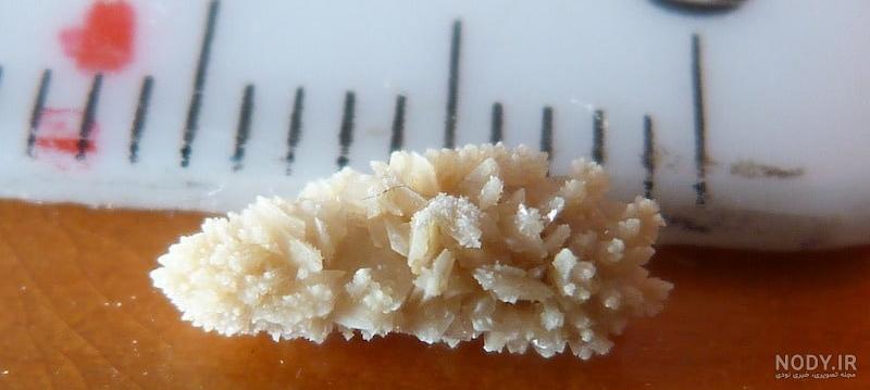 عکس سنگ کلیه 7 میلیمتری عکس سنگ کلیه 7 میلیمتری