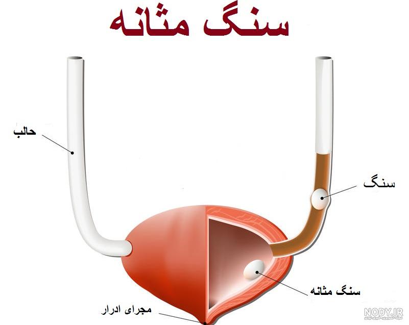 عکس سنگ کلیه سیاه رنگ عکس سنگ کلیه سیاه رنگ