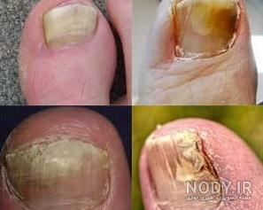 تشخیص قارچ ناخن دست تشخیص قارچ ناخن دست