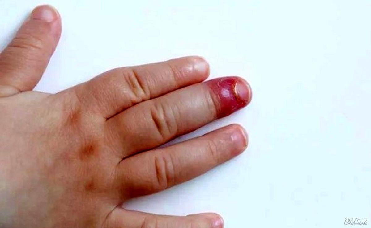 خطرات قارچ ناخن خطرات قارچ ناخن