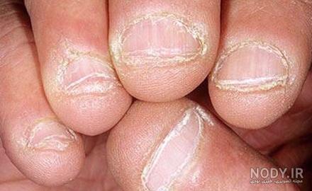 دلایل قارچ ناخن کاشت دلایل قارچ ناخن کاشت