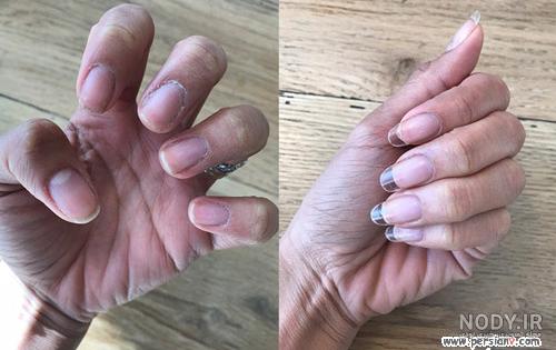کاشت ژله ای ناخن چیست کاشت ژله ای ناخن چیست