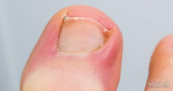 آنتی بیوتیک مناسب برای پارونیشیا