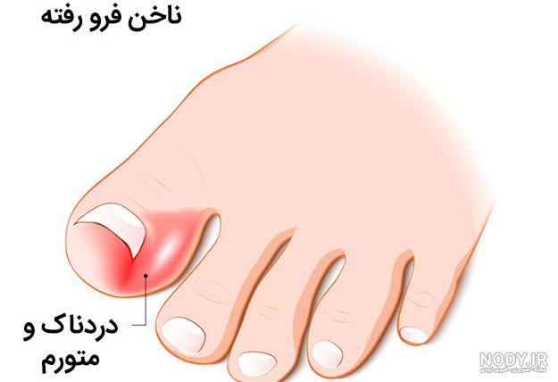 درمان خانگی عفونت گوشه ناخن دست نوزاد