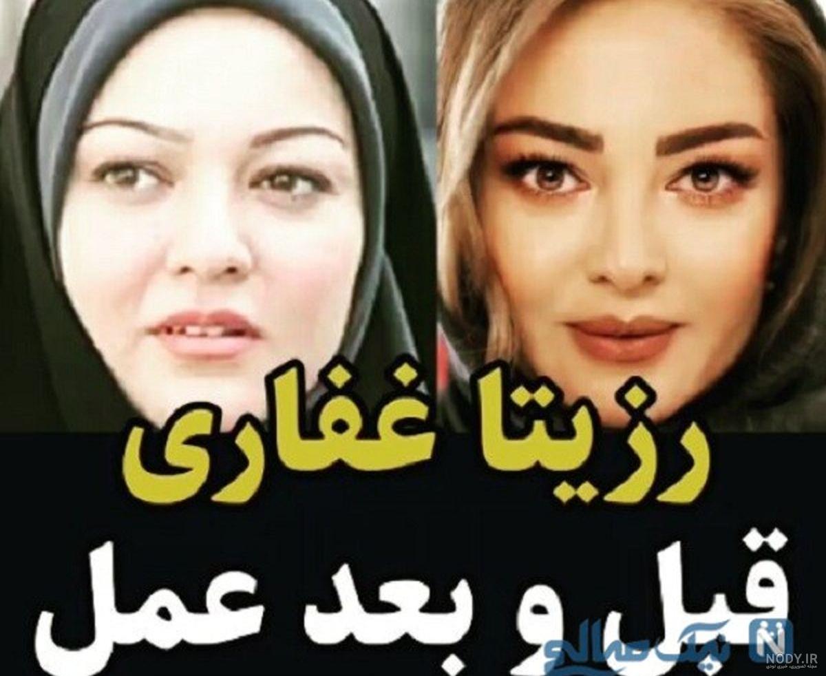 عکس رزیتا غفاری بعد از عمل عکس رزیتا غفاری بعد از عمل