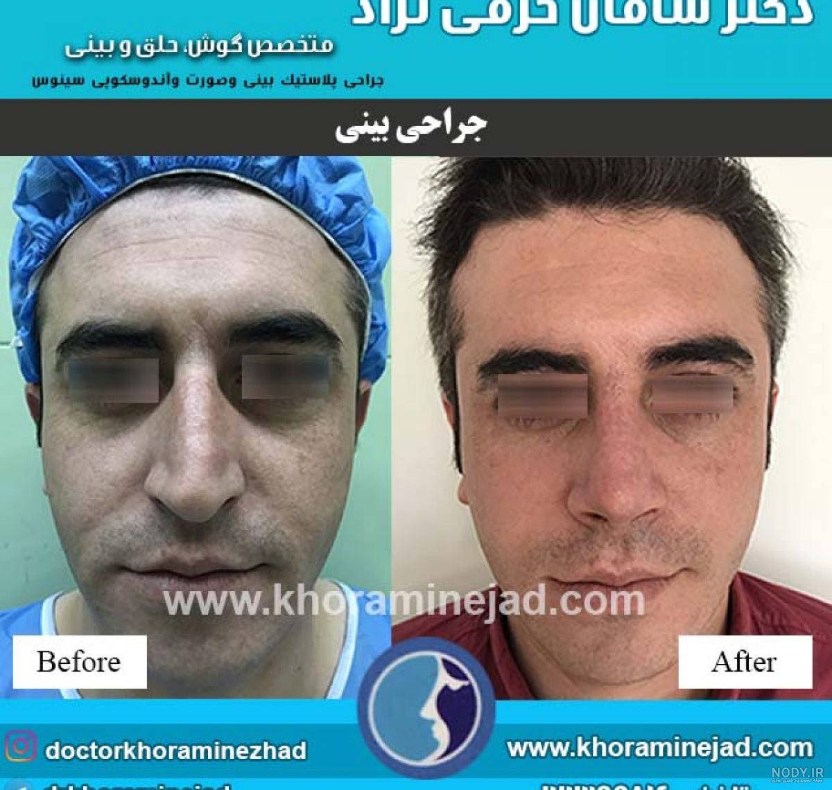عمل بینی گوشتی فانتزی عمل بینی گوشتی فانتزی