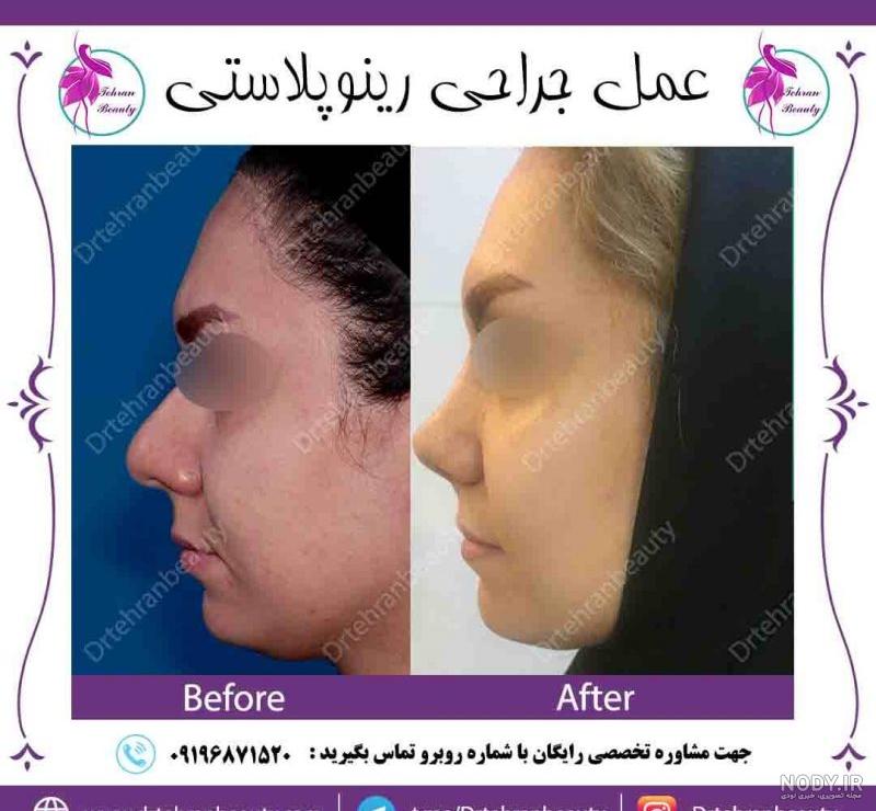 عکس دماغ عملی طبیعی دخترانه عکس دماغ عملی طبیعی دخترانه