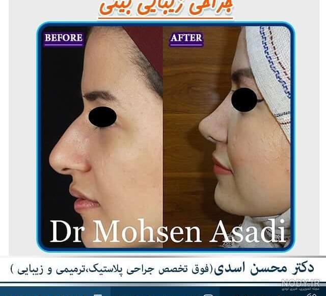 عکس دماغ عملی طبیعی دخترانه عکس دماغ عملی طبیعی دخترانه