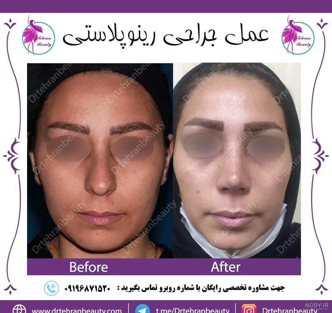 عکس دماغ عملی مردانه عکس دماغ عملی مردانه